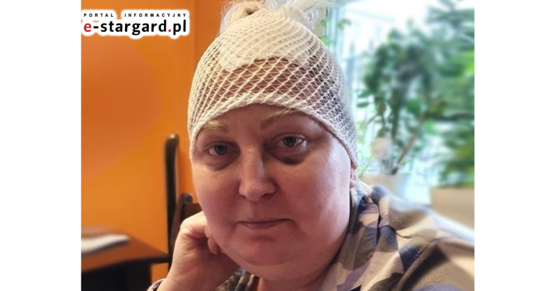 Starosta Stargardzki wspiera akcję pomocy dla Agnieszki Szumskiej, dotkniętej chorobą nowotworową